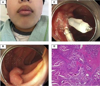 Gastrointestinal bleeding after endoscopic mucosal resection in a case of Peutz–Jeghers syndrome with <mark class="highlighted">hypofibrinogenemia</mark>: A case report
